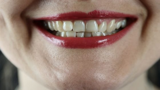 تفسير تآكل الأسنان في الحلم – رؤية تآكل الأسنان في المنام