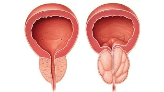 الفرق بين سرطان البروستاتا وتضخم البروستاتا