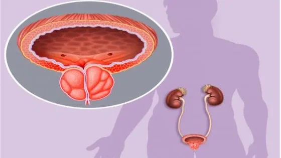 هل يمكن الشفاء من التهاب البروستاتا نهائيا