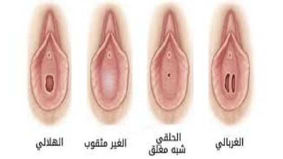 هل تختفي اللحمة الوردية بعد فض الغشاء