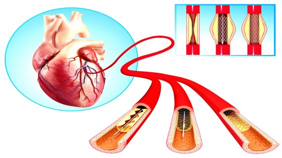 Angioplasty, computer artwork.