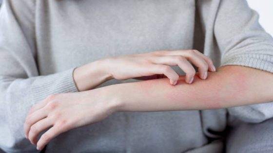 Closeup girl is scratching her hand with nails. Reddened, inflamed body parts causes discomfort and itching. Young woman is suffering from bouts of allergies. Dermatological skin diseases concept.