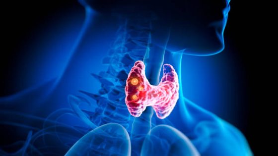 Thyroid gland with nodules inside human body - 3D illustration