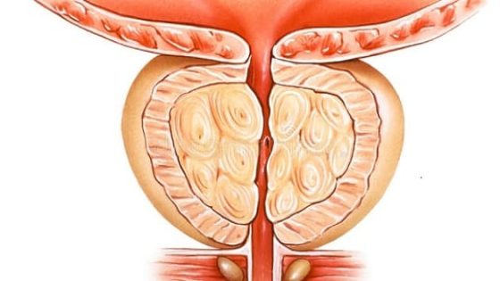 أعراض البروستاتا عند الرجال